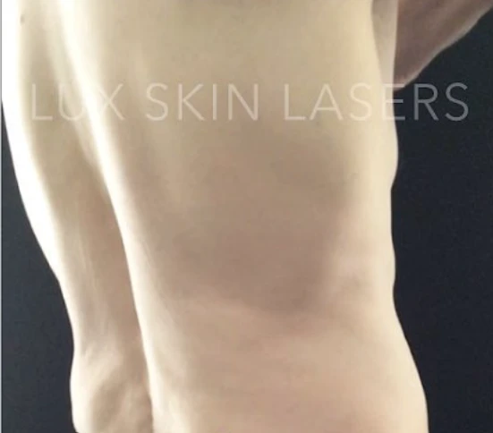 CoolSculpting B&A — after