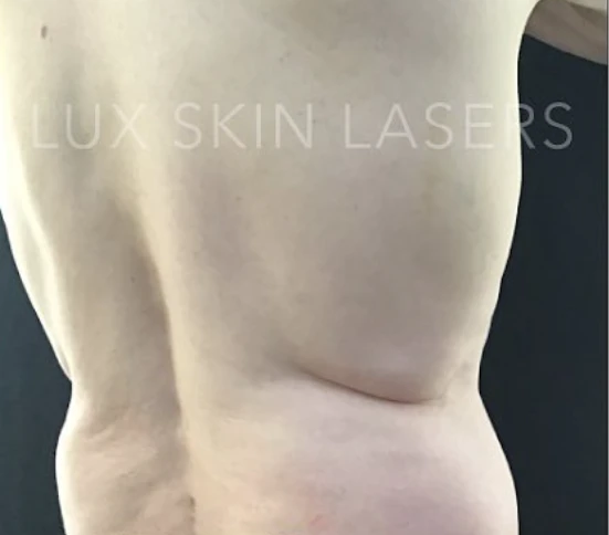CoolSculpting B&A — before