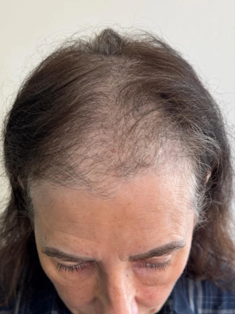Hair transplant — before