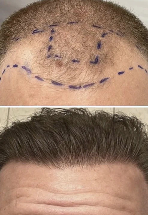 Hair Restoration with NeoGraft