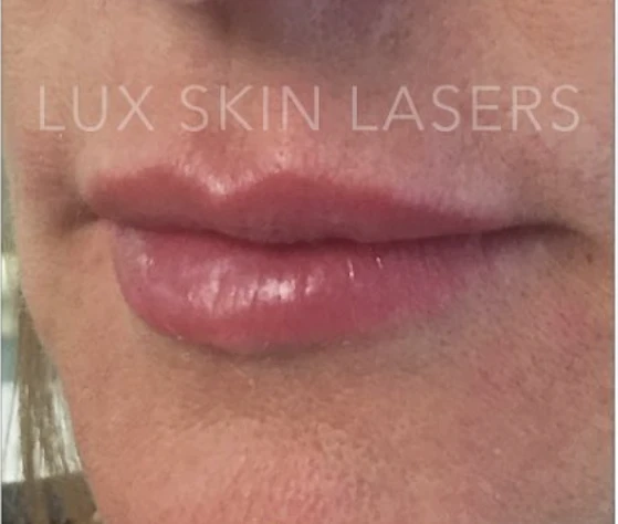 Lip Filler B&A — after