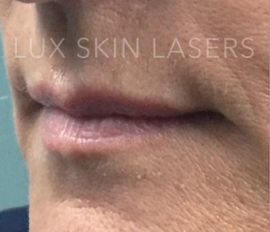 Lip Filler B&A — before