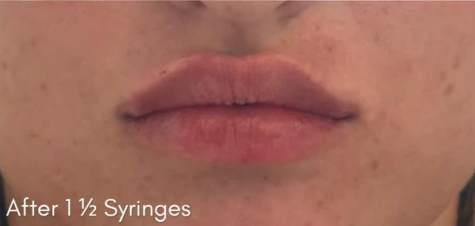 Lip Filler B&A — after