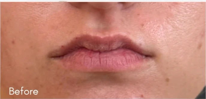 Lip Filler B&A — before