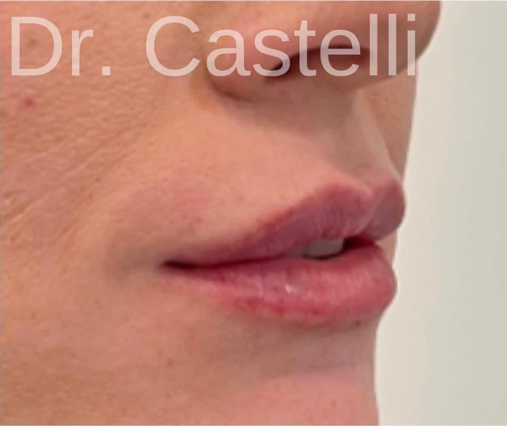 Lip filler — after