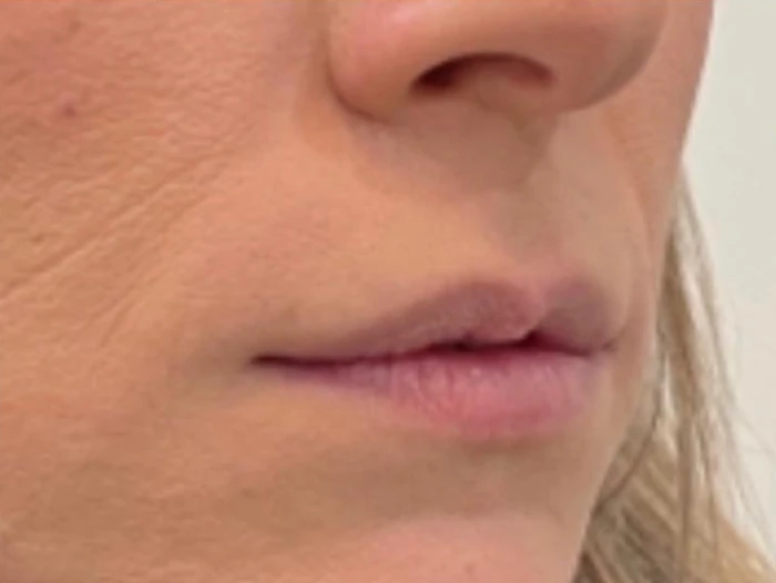 Lip filler — before