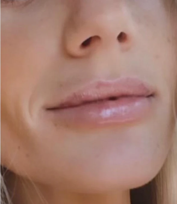 Lip filler — after