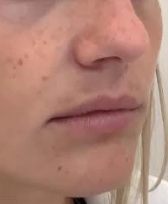 Lip filler — before