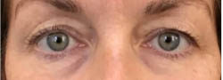 Facial Surgery B&A — before