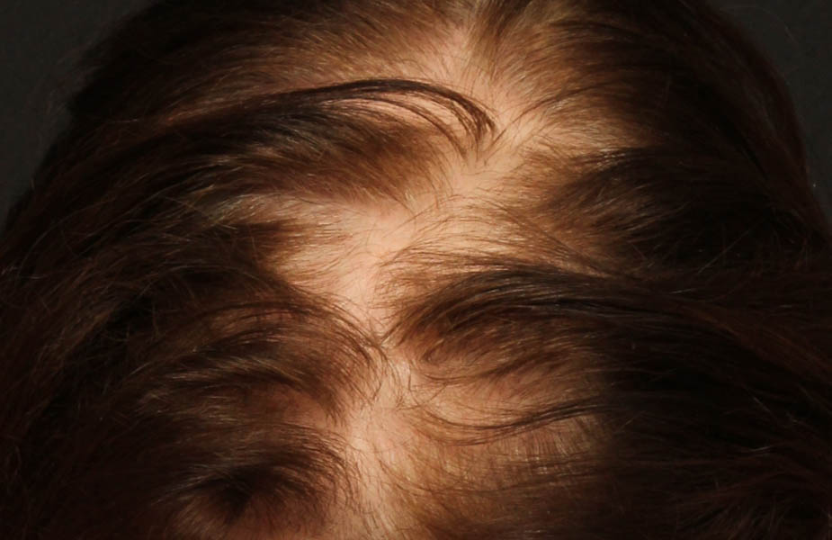 Hair Restoration with NeoGraft B&A — before