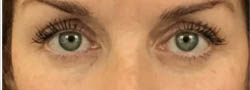 Facial Surgery B&A — after