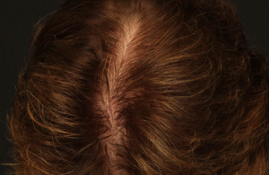 Hair Restoration with NeoGraft B&A — after