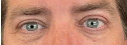 Facial Surgery B&A — after