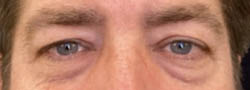 Facial Surgery B&A — before