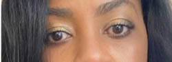 Facial Surgery B&A — after