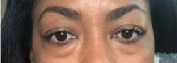 Facial Surgery B&A — before