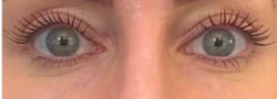 Facial Surgery B&A — after