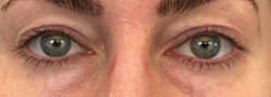 Facial Surgery B&A — before