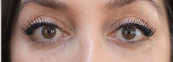 Facial Surgery B&A — after
