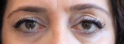 Facial Surgery B&A — before