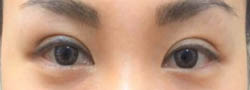 Facial Surgery B&A — after