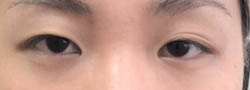 Facial Surgery B&A — before