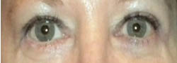 Facial Surgery B&A — after