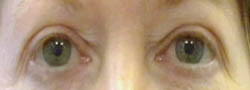 Facial Surgery B&A — before