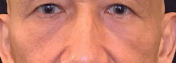 Facial Surgery B&A — after
