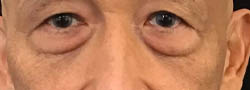 Facial Surgery B&A — before