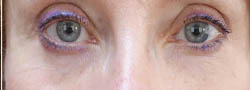 Facial Surgery B&A — after