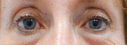 Facial Surgery B&A — before