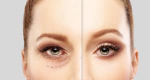 woman's face before and after eye cosmetic surgery