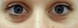 Facial Fillers B&A — before
