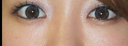 Under Eye Fillers B&A — after