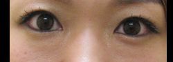 Under Eye Fillers B&A — before