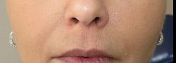 Facial Fillers B&A — after