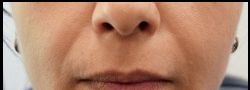 Facial Fillers B&A — before
