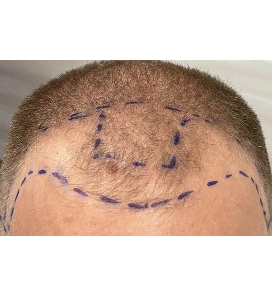 Hair Restoration B&A — before