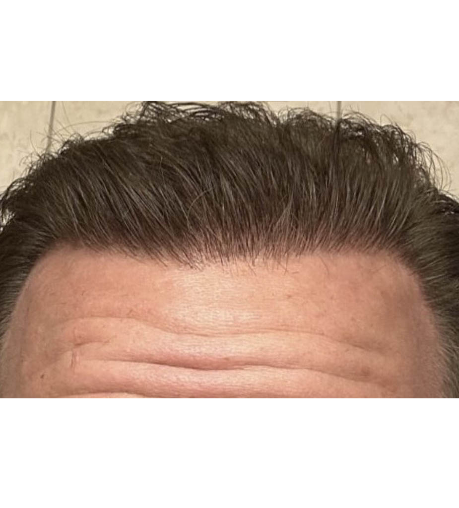 Hair Restoration B&A — after