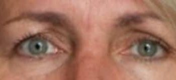 Upper Eyelid Surgery B&A — before