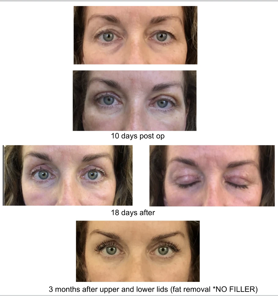 Healing timeline after upper and lower eyelid surgery — 10 days, 18 days, and 3 months post-op