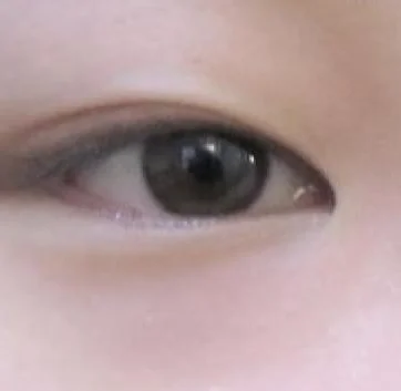 Asian Eyelid Surgery