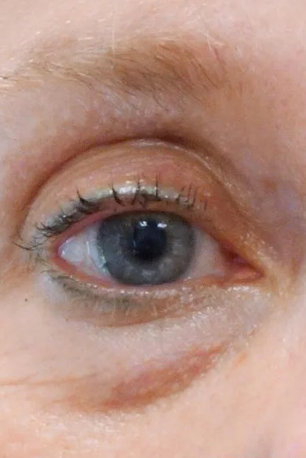 Lower Eyelid Surgery