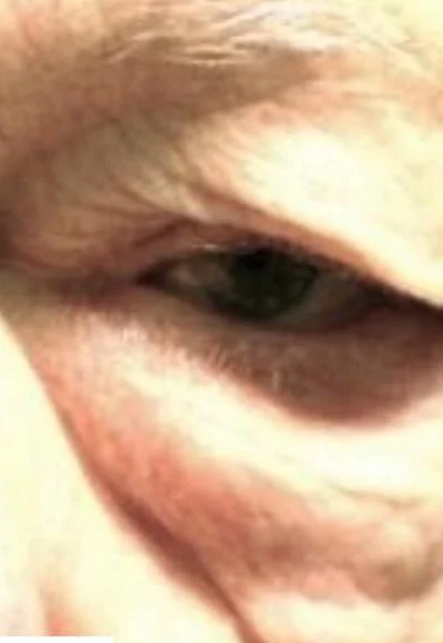 Ptosis: Causes & Treatments