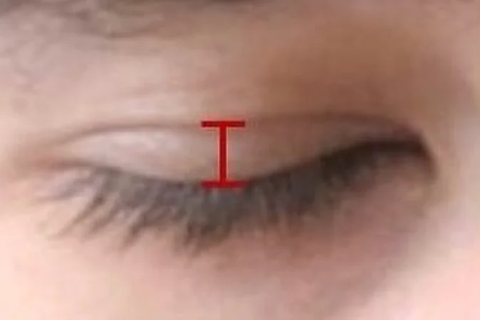 Eyelid Surgery