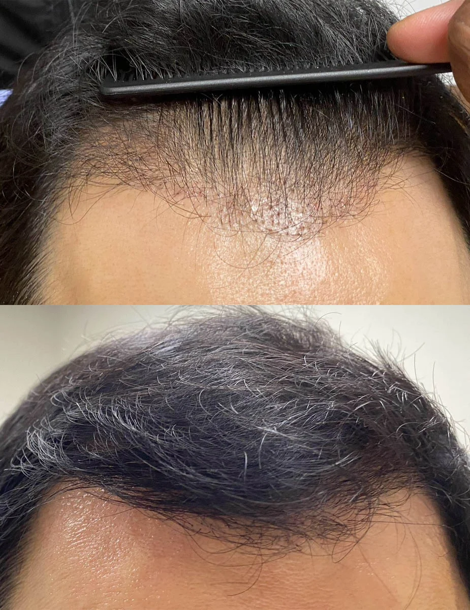 hairrestorationintro (1)