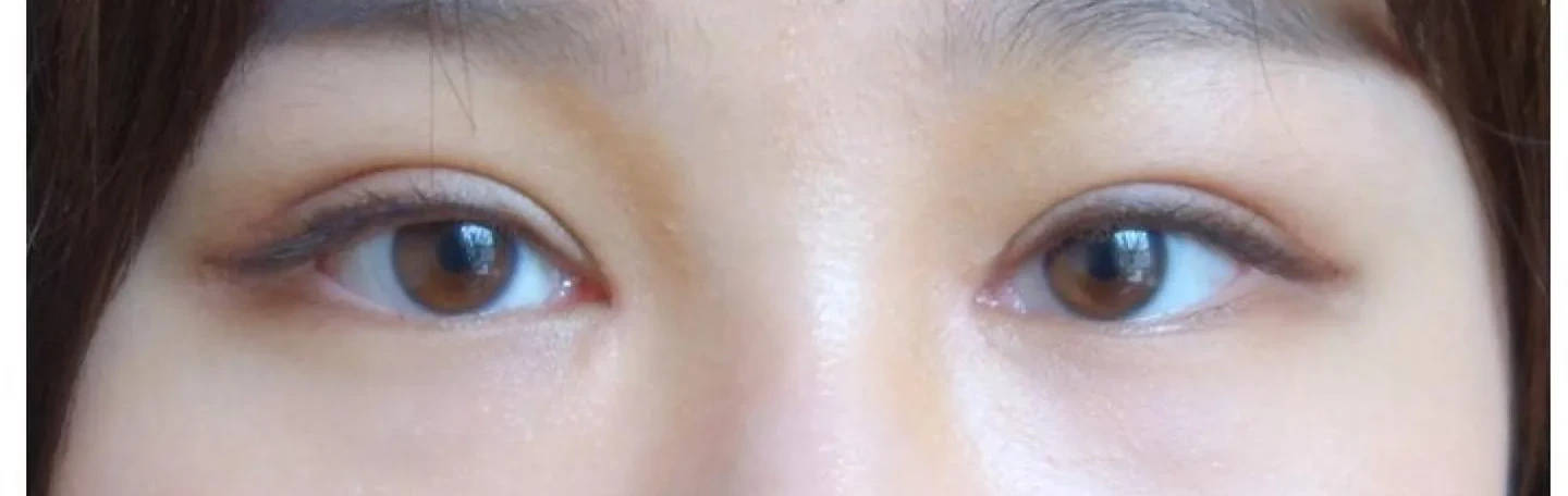 After — Asian Eyelid Surgery, actual patient of Dr. John J.W. Lee