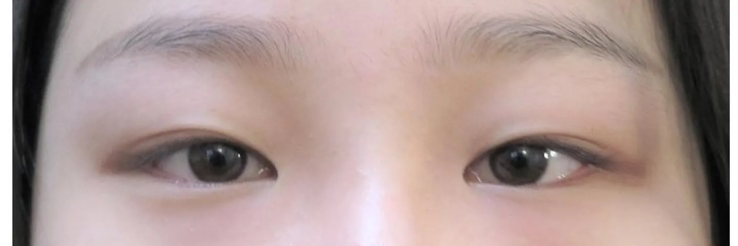 Before — Asian Eyelid Surgery, actual patient of Dr. John J.W. Lee