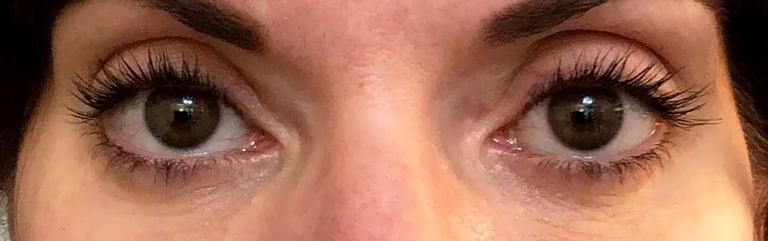 After — Botox Brow Lift, actual patient of Dr. John J.W. Lee